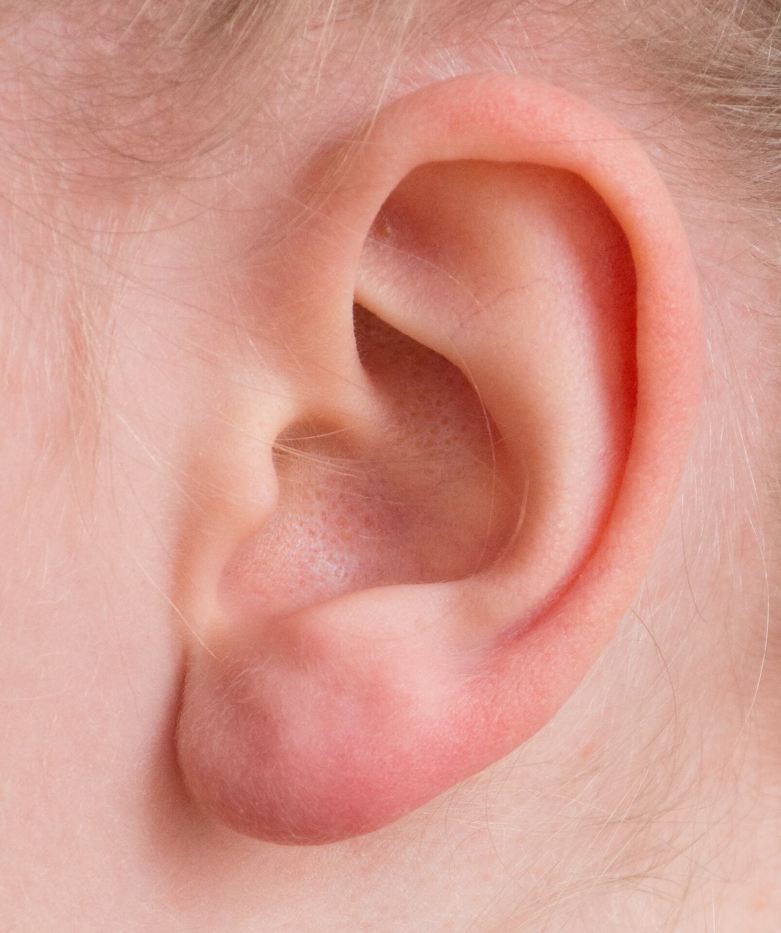 tinnitus